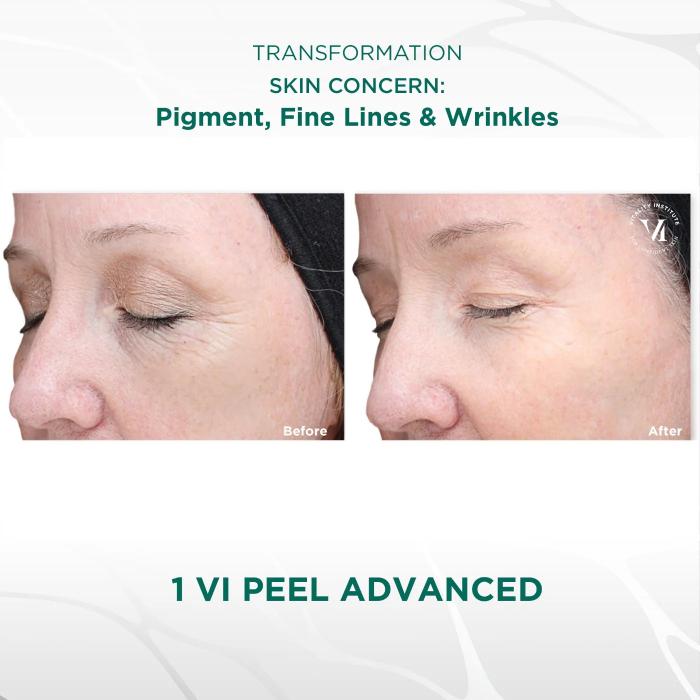 VIPeel_Advanced_BeforeandAfter2_1400x.jpg