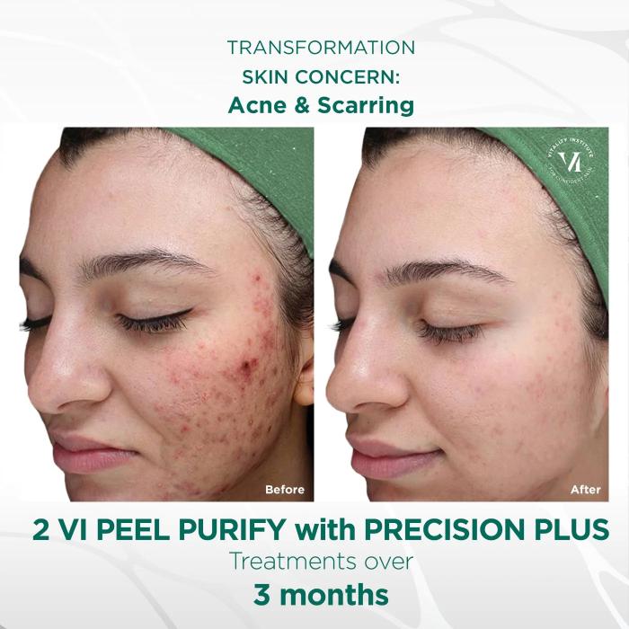 VIPeel_PurifyWITHPrecisionPlus_BeforeandAfter2_1400x.jpg